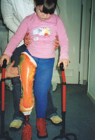 Foto: Nastja mit Prothese